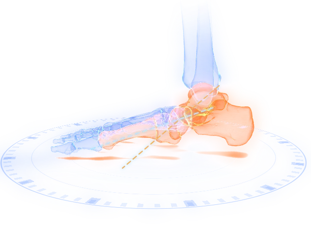 Flexible flatfoot reconstruction: the deformity on the model
