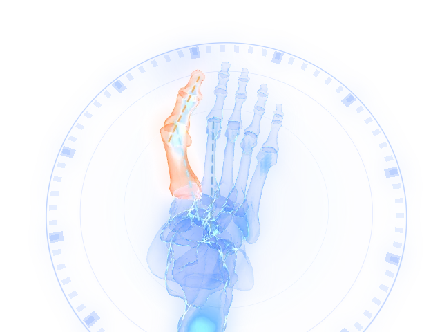 Hallux valgus surgery: the deformity on the model